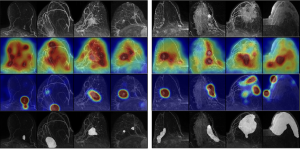 Fyra rader svartvita och färgröntgenbilder av tät bröstvävnad.